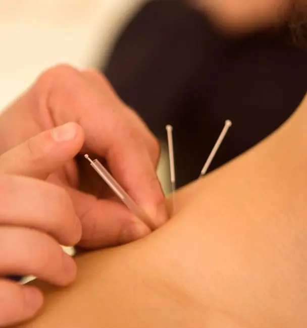 Woman receiving acupuncture